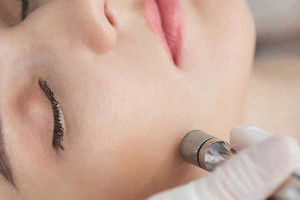 Microdermabrasion Facial